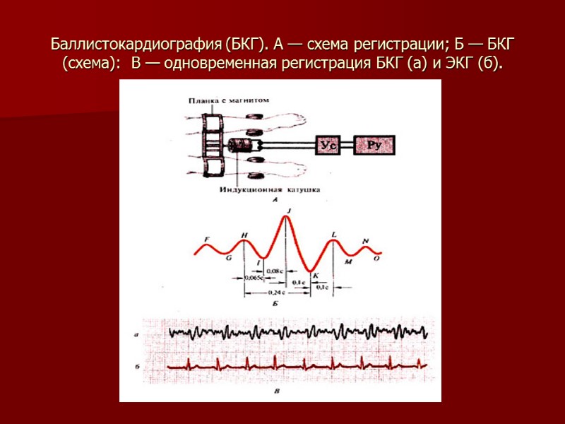 Баллистокардиография (БКГ). А — схема регистрации; Б — БКГ (схема):  В — одновременная